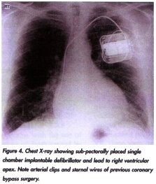 Figure 4. Chesht xray showing sub pectorally placed single chamber implantable defibrillator and lead to right ventricular apex. Note arterial clips and sternal wires of previous coronary bypass surgery.